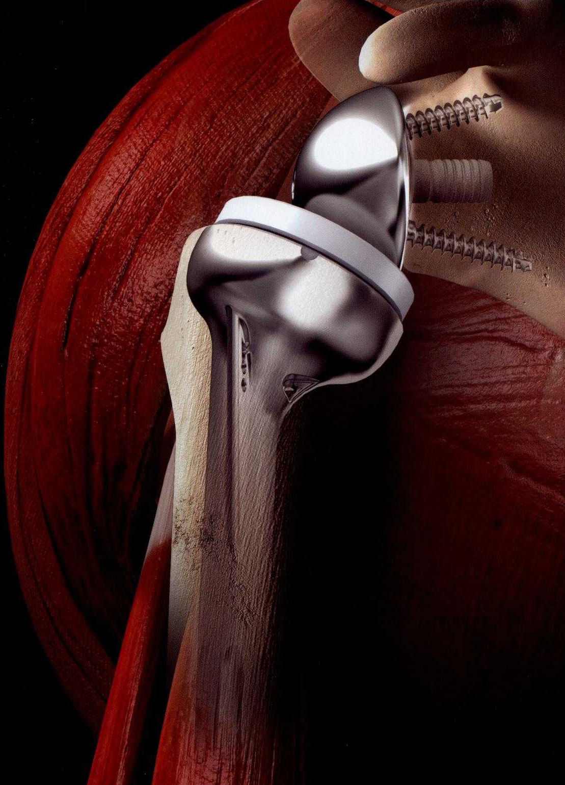 Sogenannte Umkehrprothese oder Inverse Prothese nach Grammont